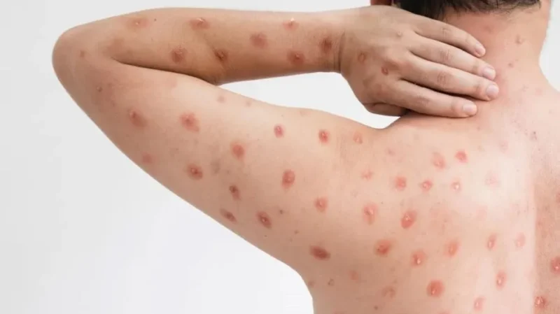 Confirman el primer caso de la variante más peligrosa de la viruela del mono en Argentina